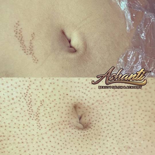 Ashanti Beauty Salon & Academy #beograd Tretman lica Plasma pen - stomak