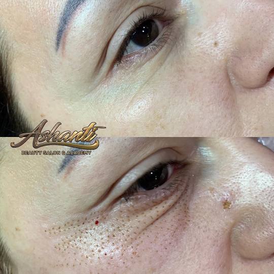Ashanti Beauty Salon & Academy #beograd Tretman lica Plasma pen - podočnjaci