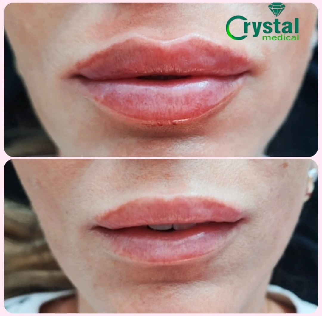 Crystal Medical #beograd Hijaluronski tretmani lica Povećanje usana hijaluronskim filerom - 1 ml
