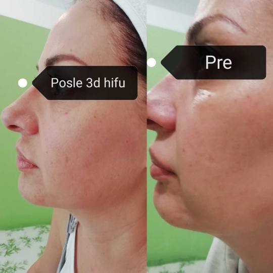 Olja Beauty #beograd Lifting / zatezanje kože HiFu tretman lica - po regiji 3D HIFU nehirusko zatez