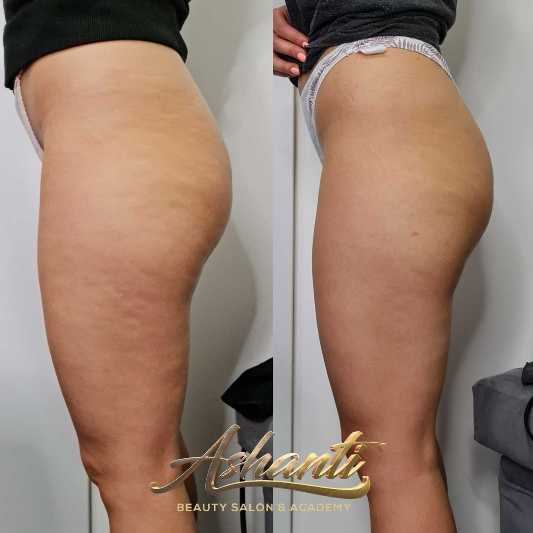 Ashanti Beauty Salon & Academy #beograd Tretmani tela Ultrazvučna kavitacija + radiotalasni lifting - po regiji