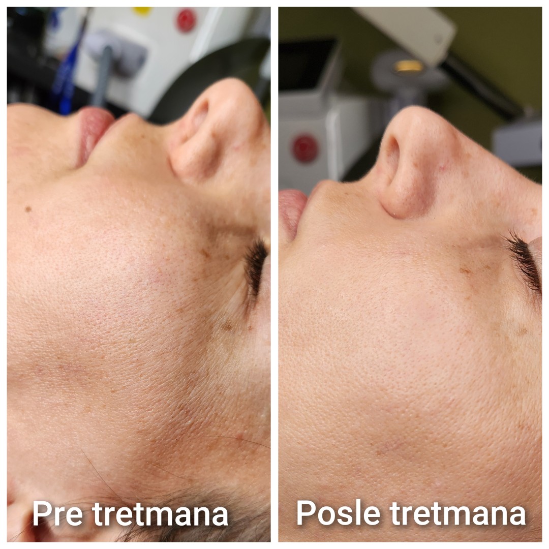 Mango beauty studio #novisad Tretman lica Hidrodermoabrazija