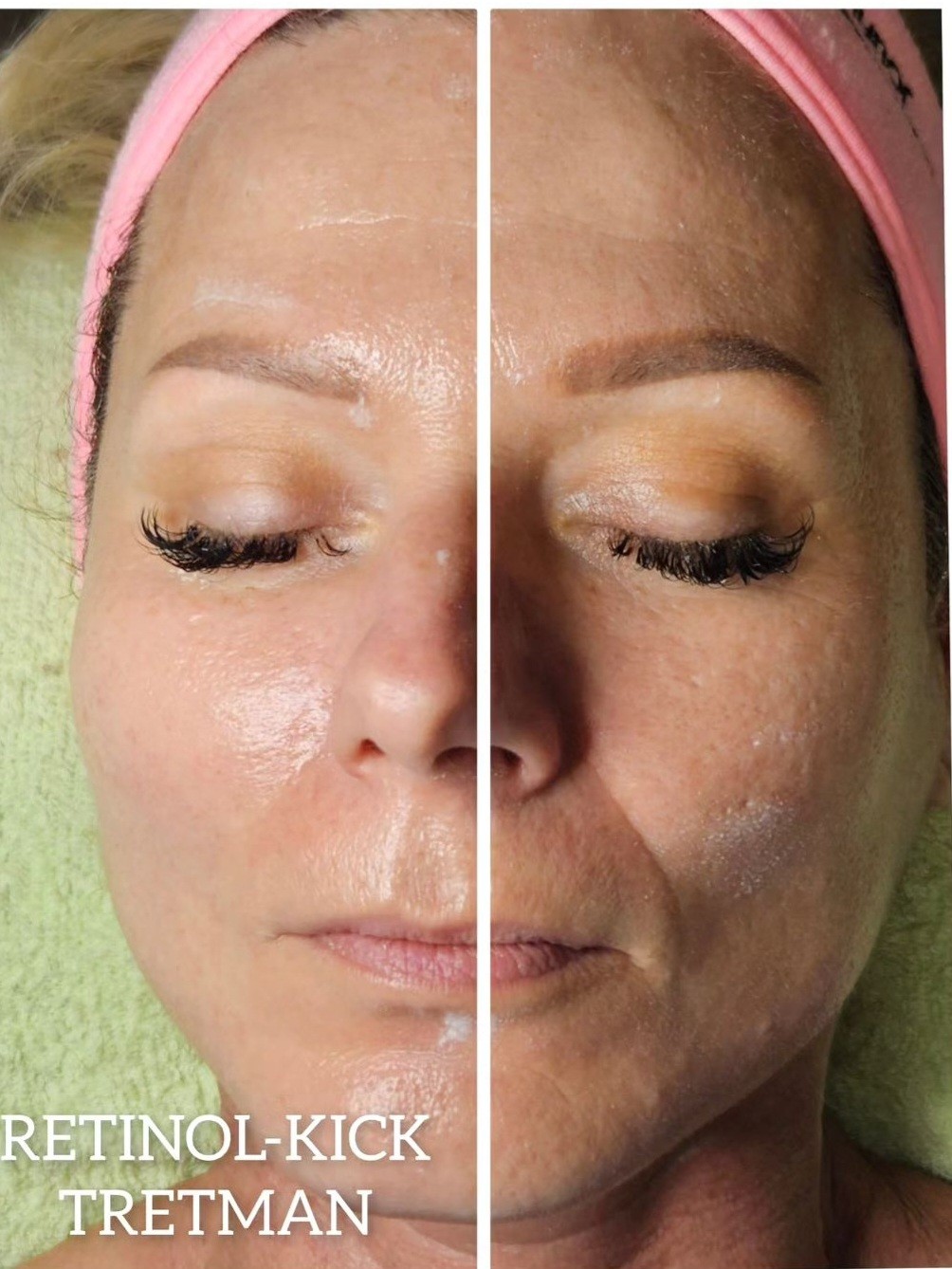 Beauty salon XL Lady #beograd Tretman lica Enzimski piling Retinol Kick - full tretman