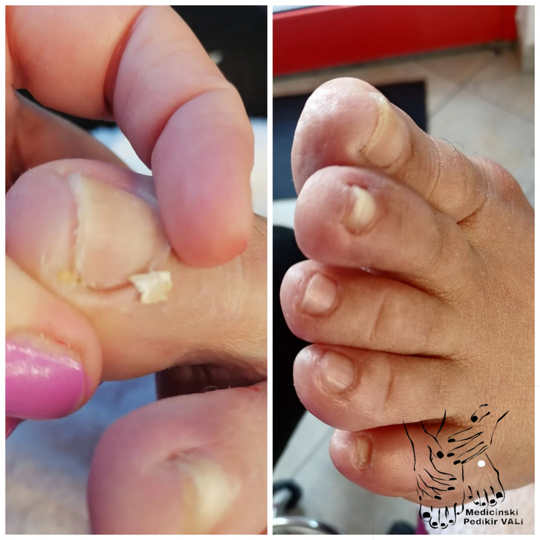 Vali&Nađa #novisad Medicinski pedikir Medicinski pedikir + urasli nokat