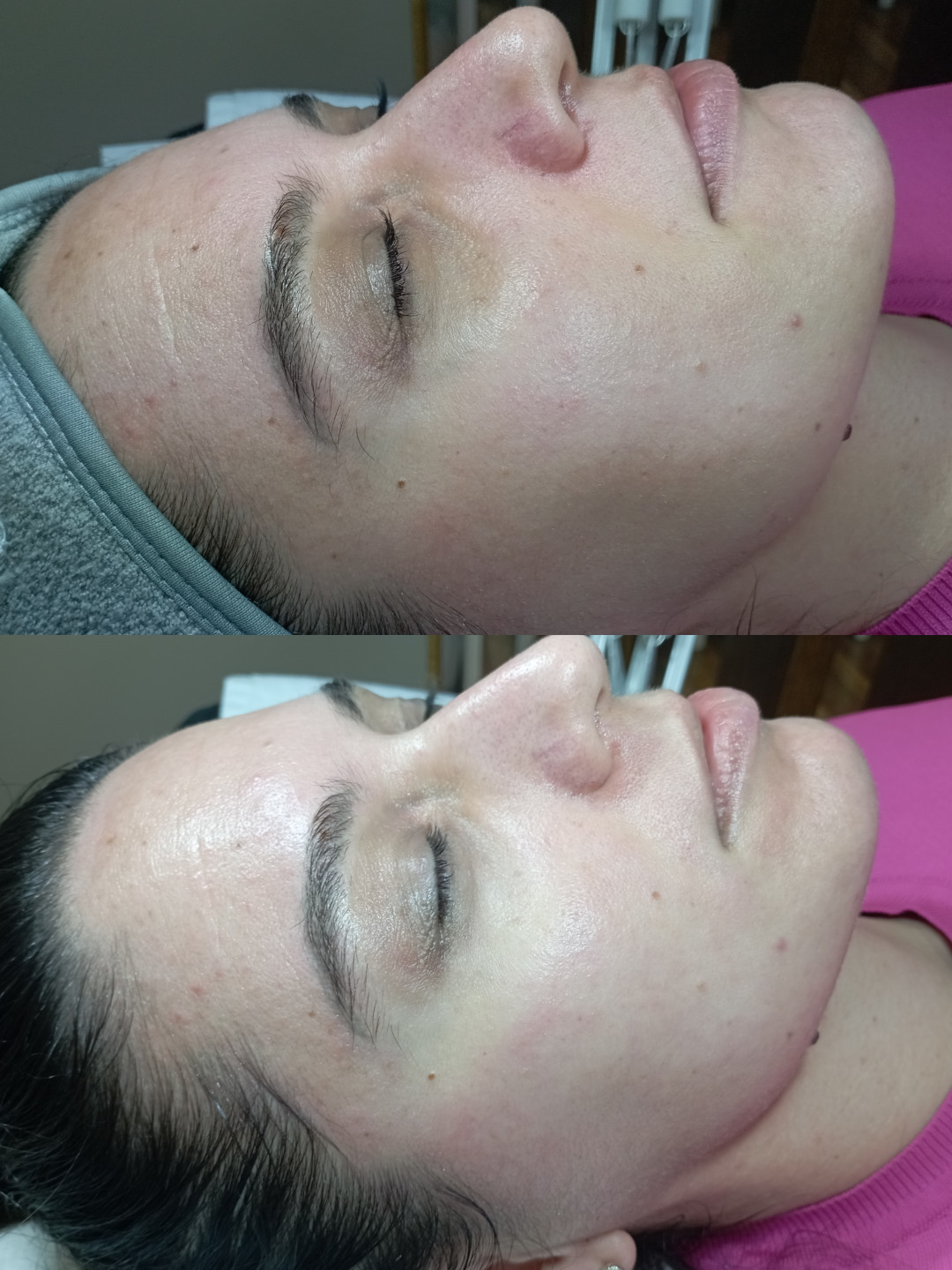 Factor Estetic #beograd Tretman lica Biorevitalizacija lica