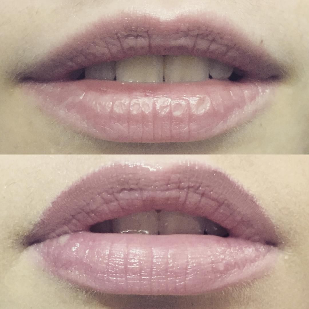 Plasma pen -  lip flip usne - Ashanti Beauty Salon & Academy, Beograd Tretman lica Lice Tretman lica, Beograd, Voždovac