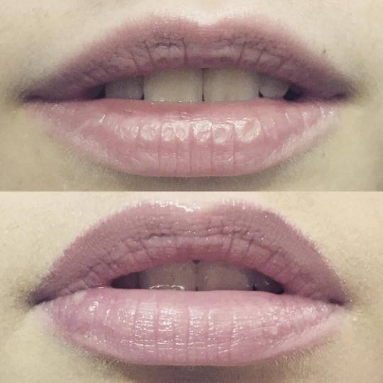 Ashanti Beauty Salon & Academy #beograd Tretman lica Plasma pen -  lip flip usne