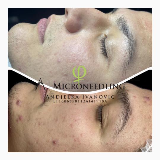 Belle Ana #beograd Tretman lica Microneedling tretman - lice