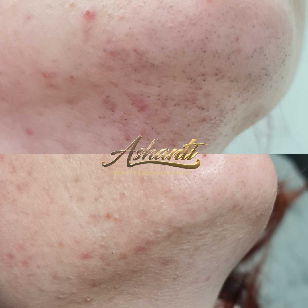 Ashanti Beauty Salon & Academy #beograd Laserska epilacija Laserska epilacija brade + podbrade