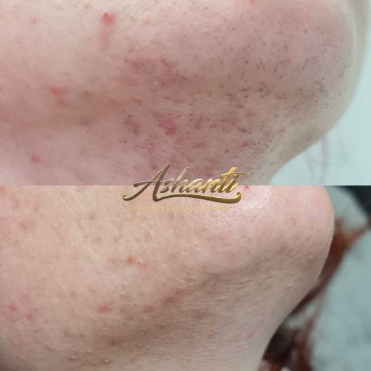 Ashanti Beauty Salon & Academy #beograd Laserska epilacija Laserska epilacija brade + podbrade
