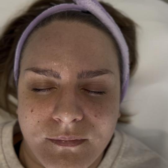 Sandra estetik studio #beograd Tretman lica Mezoporacija lica Danas smo radile mezoporaciju uz Cica 