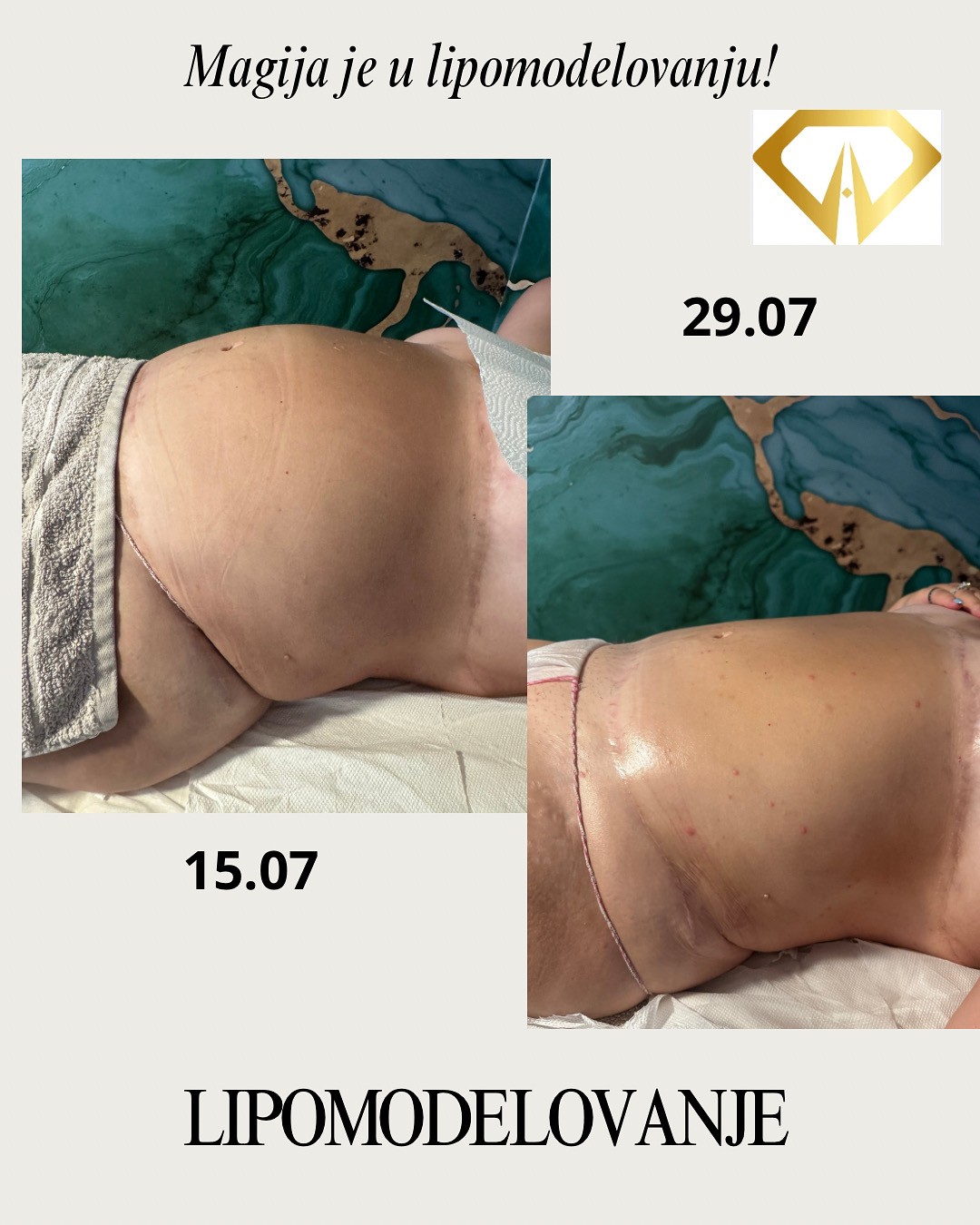 Lipomodelovanje gornjeg dela tela - Beauty and nutrition, Beograd Anticelulit masaža Masaža Anticelulit masaža, Beograd, Zvezdara