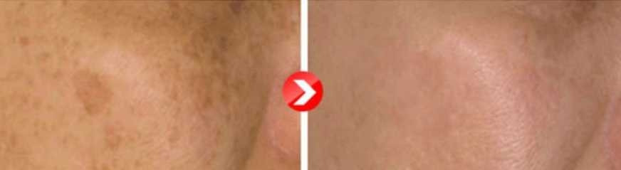 Slatka moja #beograd Mezoterapija lica Mezoterapija lica - dermapen mikroiglice