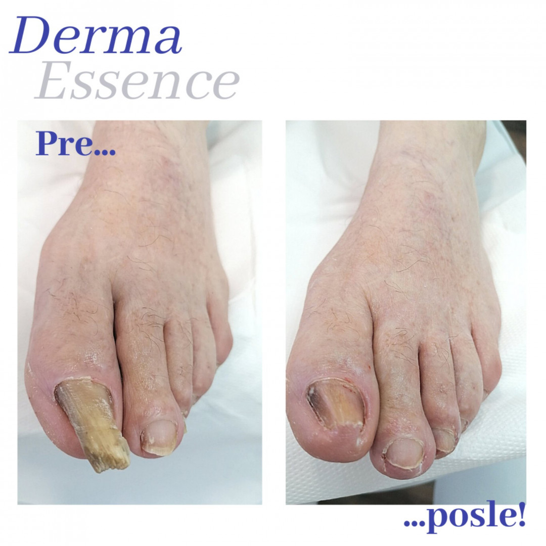 Derma Essence #nis Medicinski pedikir Kompleksni medicinski pedikir