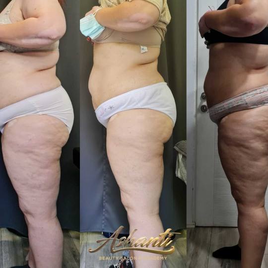 Ashanti Beauty Salon & Academy #beograd Masaža za mršavljenje Vacuslim 48 / Vacuumfit - stomak + b