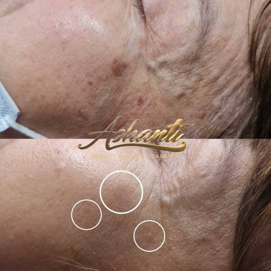 Ashanti Beauty Salon & Academy #beograd Tretman lica Uklanjanje virusnih bradavica