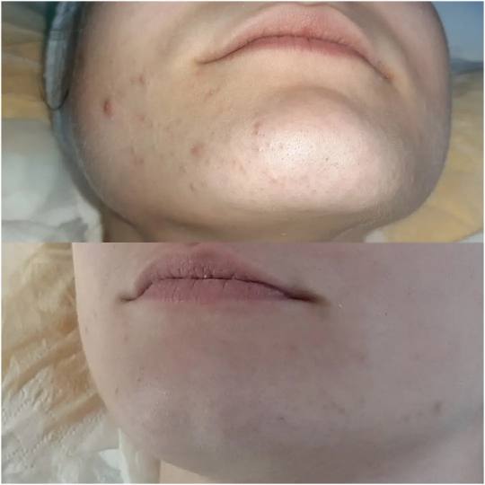 Elin Sary Mary Kutak #beograd Mlada, problematična koža lica je uvek bila moj izazov i moja ljubav