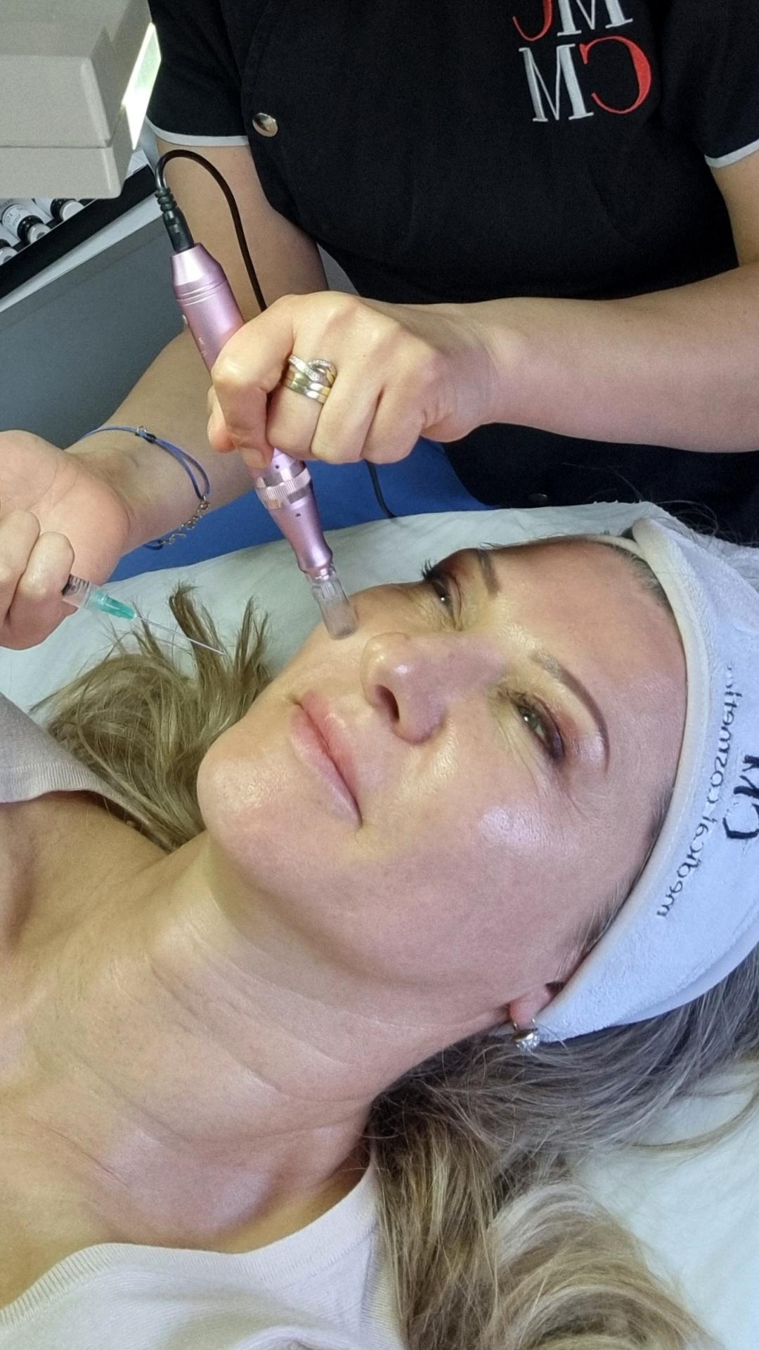 Dermapen - Emilly, Beograd Dermaroler i dermapen Lice Dermaroler i dermapen, Beograd, Dušanovac, Šumice