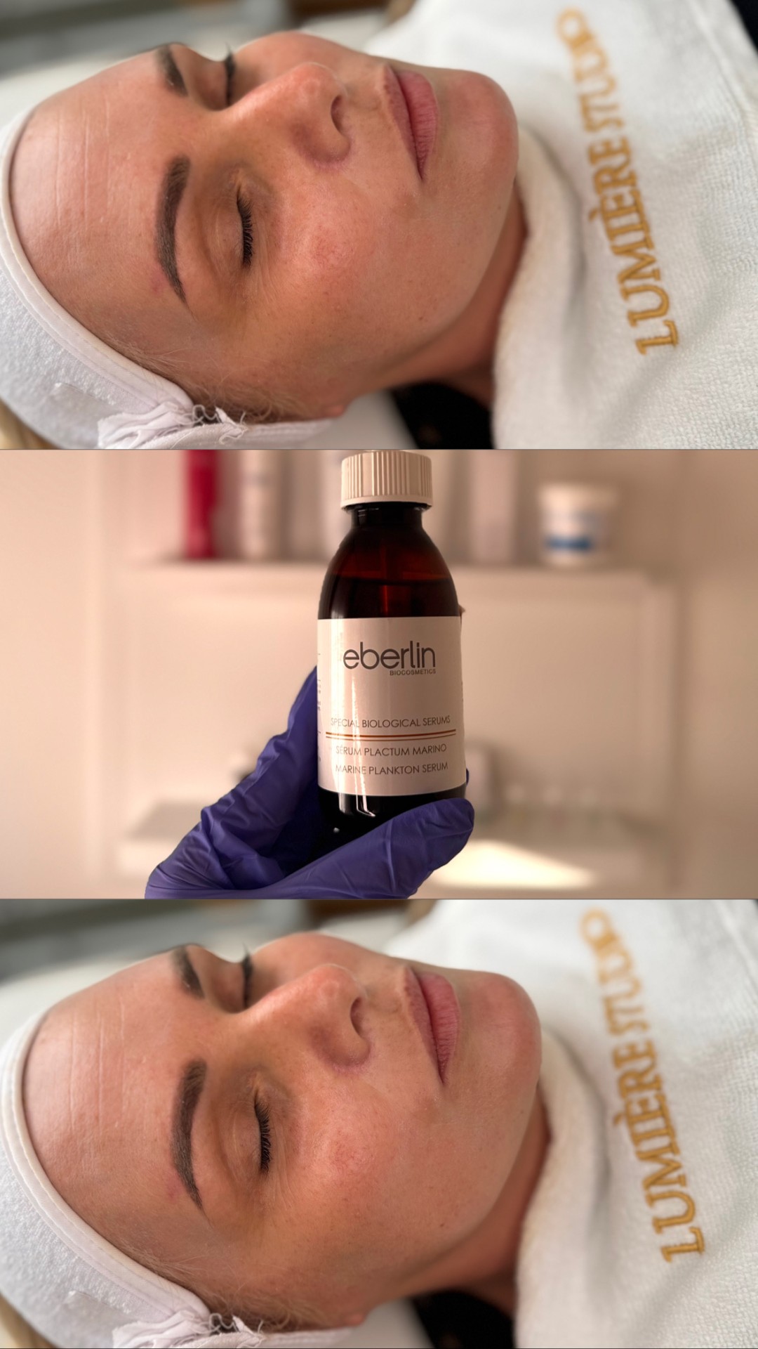 Hidrafacial tretman lica - Lumière studio, Beograd Tretman lica Lice Tretman lica, Beograd, Voždovac