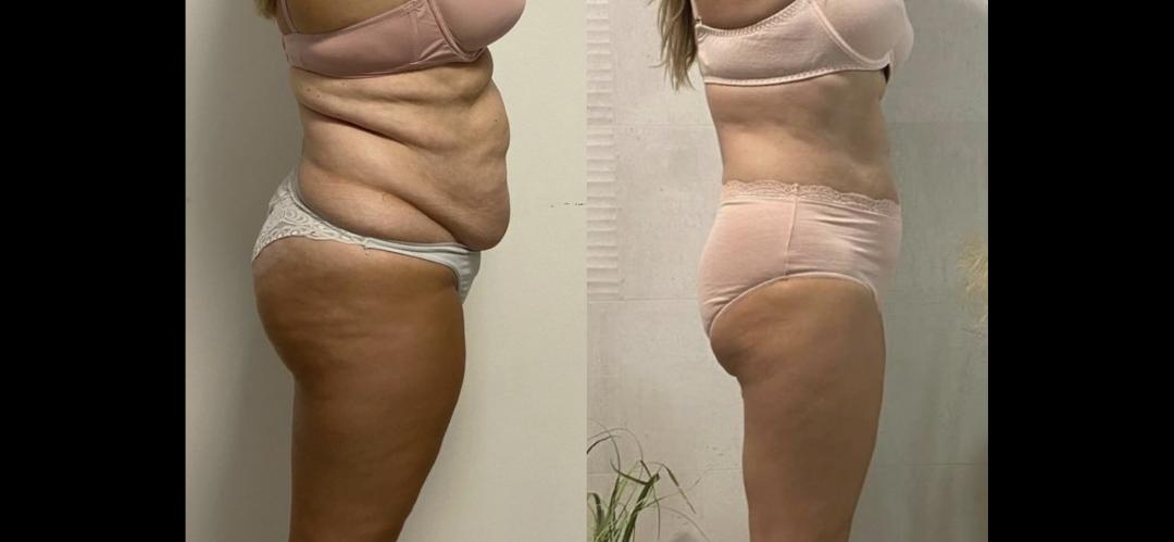 Belle Ana #beograd Kavitacija Kavitacija - po regiji