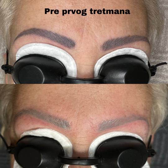 Kult #beograd Laserski tretmani lica Lasersko uklanjanje obrva