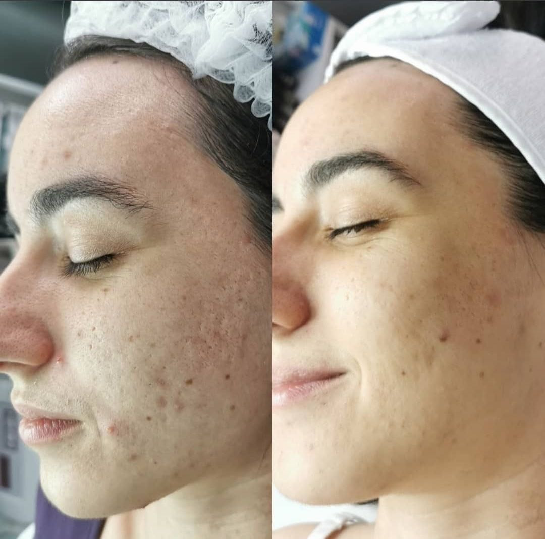 Dermapen - lice - Lipo Centar, Beograd Tretman lica Lice Tretman lica, Beograd, Zvezdara