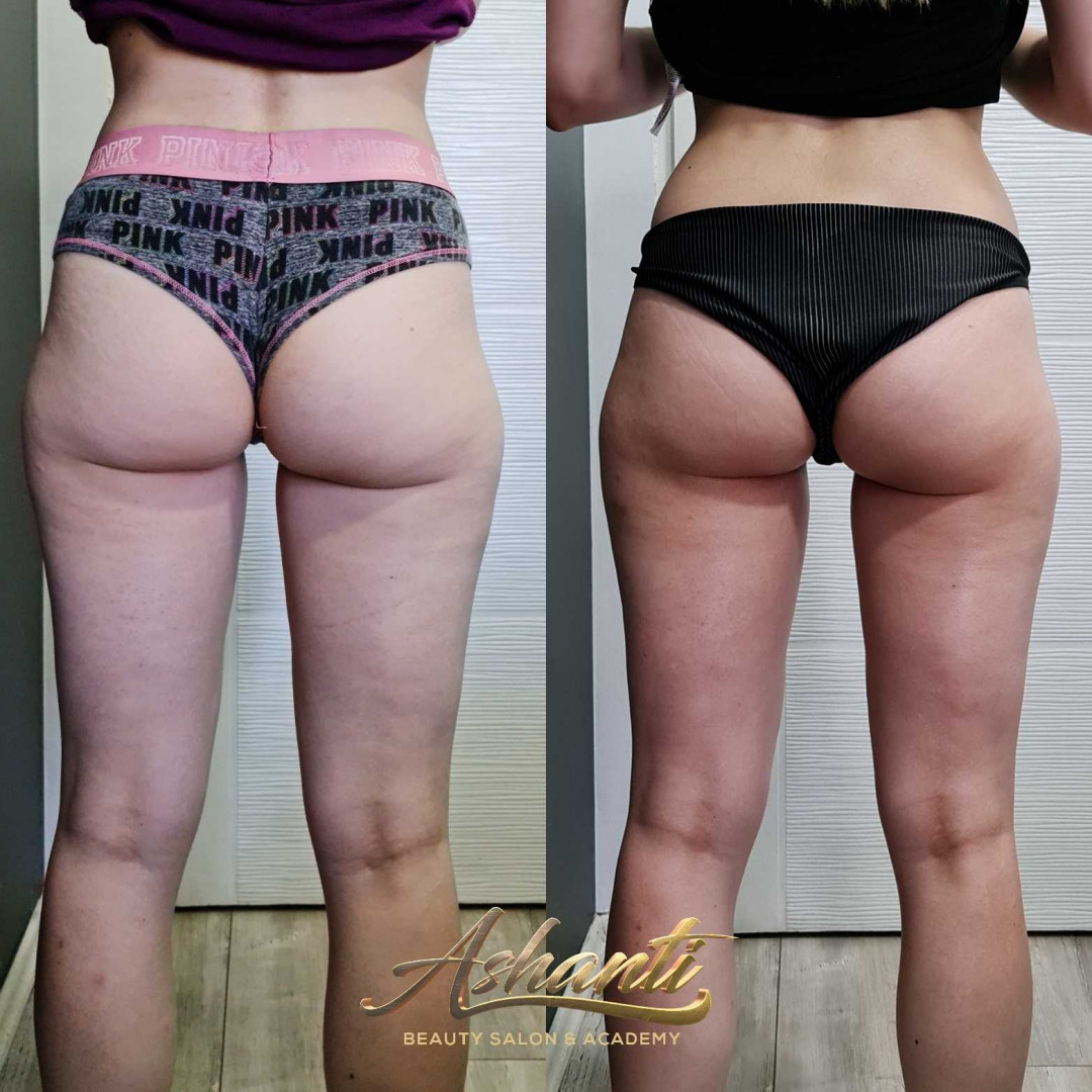 Ashanti Beauty Salon & Academy #beograd Masaža za mršavljenje Dermapen - regija lica