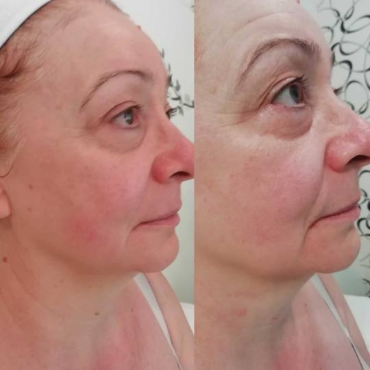 Olja Beauty #beograd Lifting / zatezanje kože HiFu tretman lica - po regiji 3D HIFU nehirusko zatez