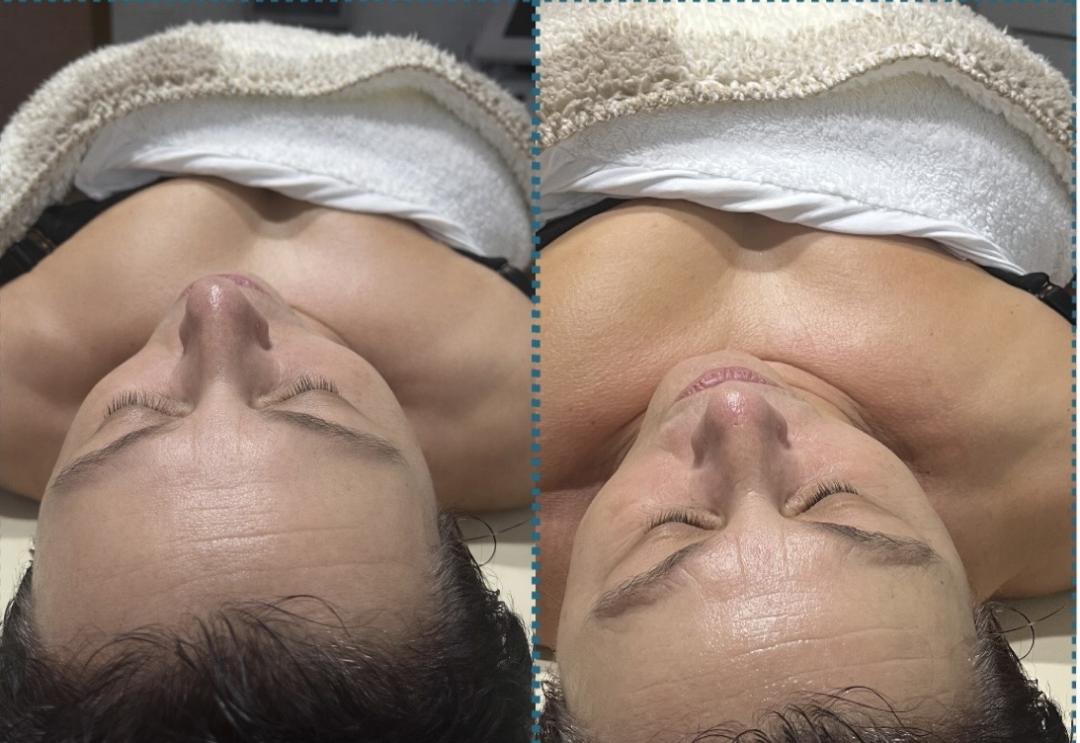 Amelini beauty concept #beograd Dermaroler i dermapen Skinpen-dermapen