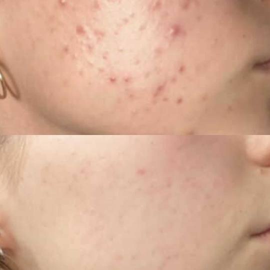 Contessa #novisad Tretman lica Acne stop