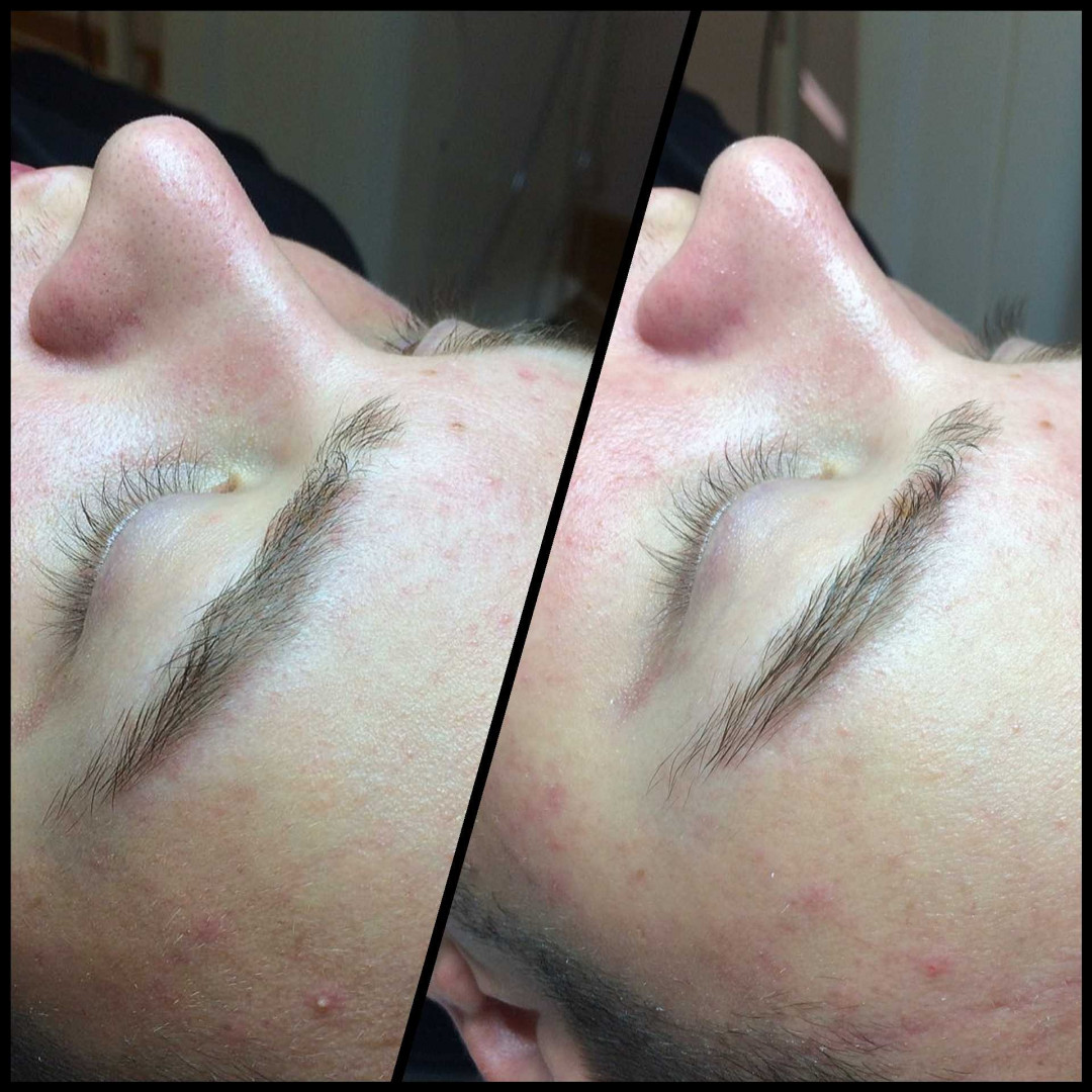 Skin Expert Aesthetic & Laser centar #beograd Radiotalasni i ultrazvučni tretmani Ultrazvučno čišćenje lica