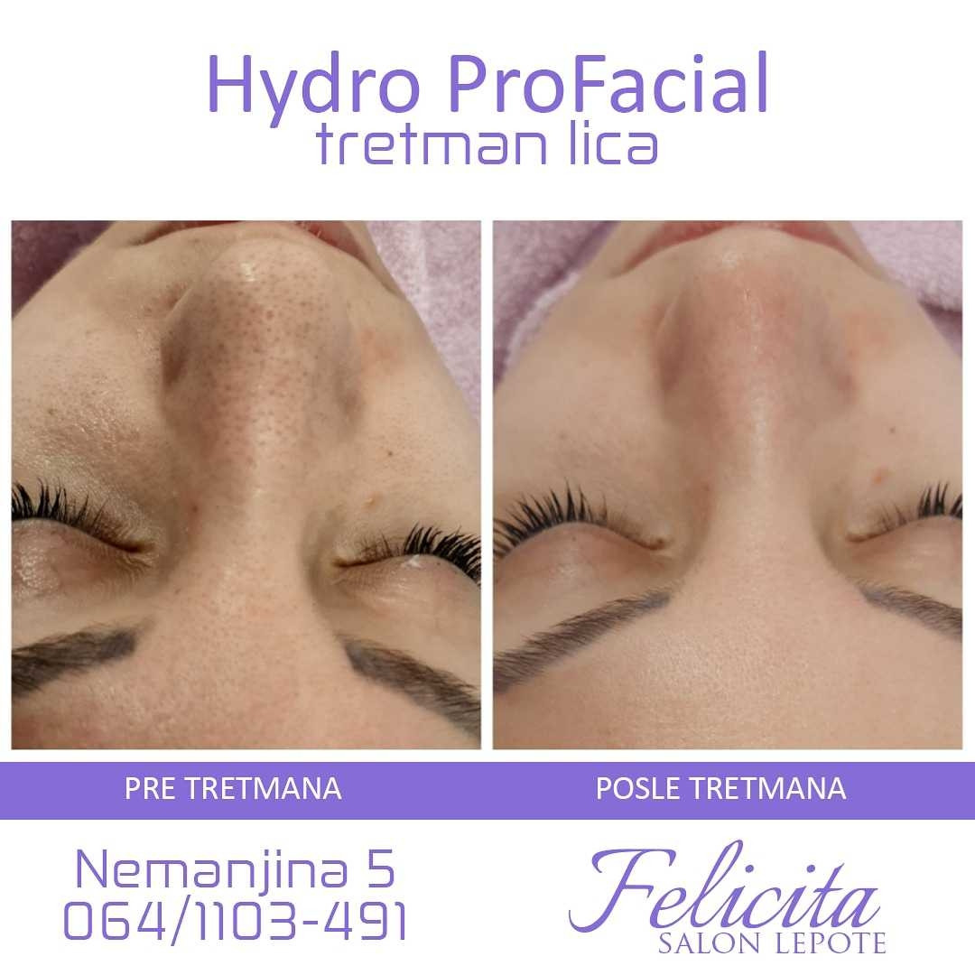 Felicita #beograd Tretman lica Hydro Pro Facial 7in1