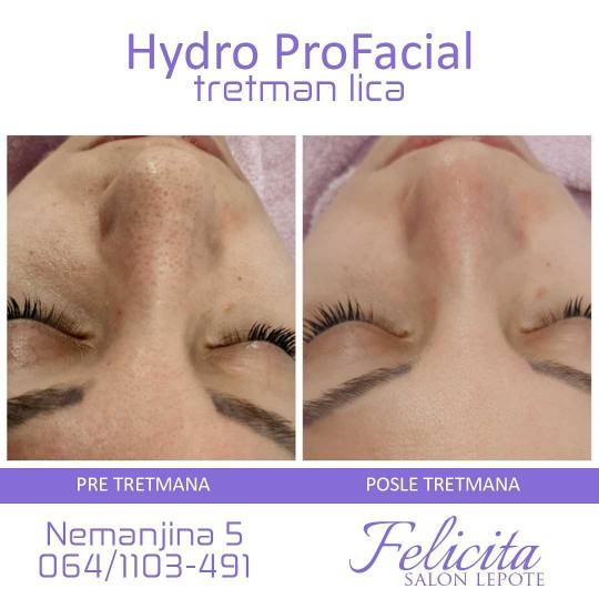 Felicita #beograd Tretman lica Hydro Pro Facial 7in1