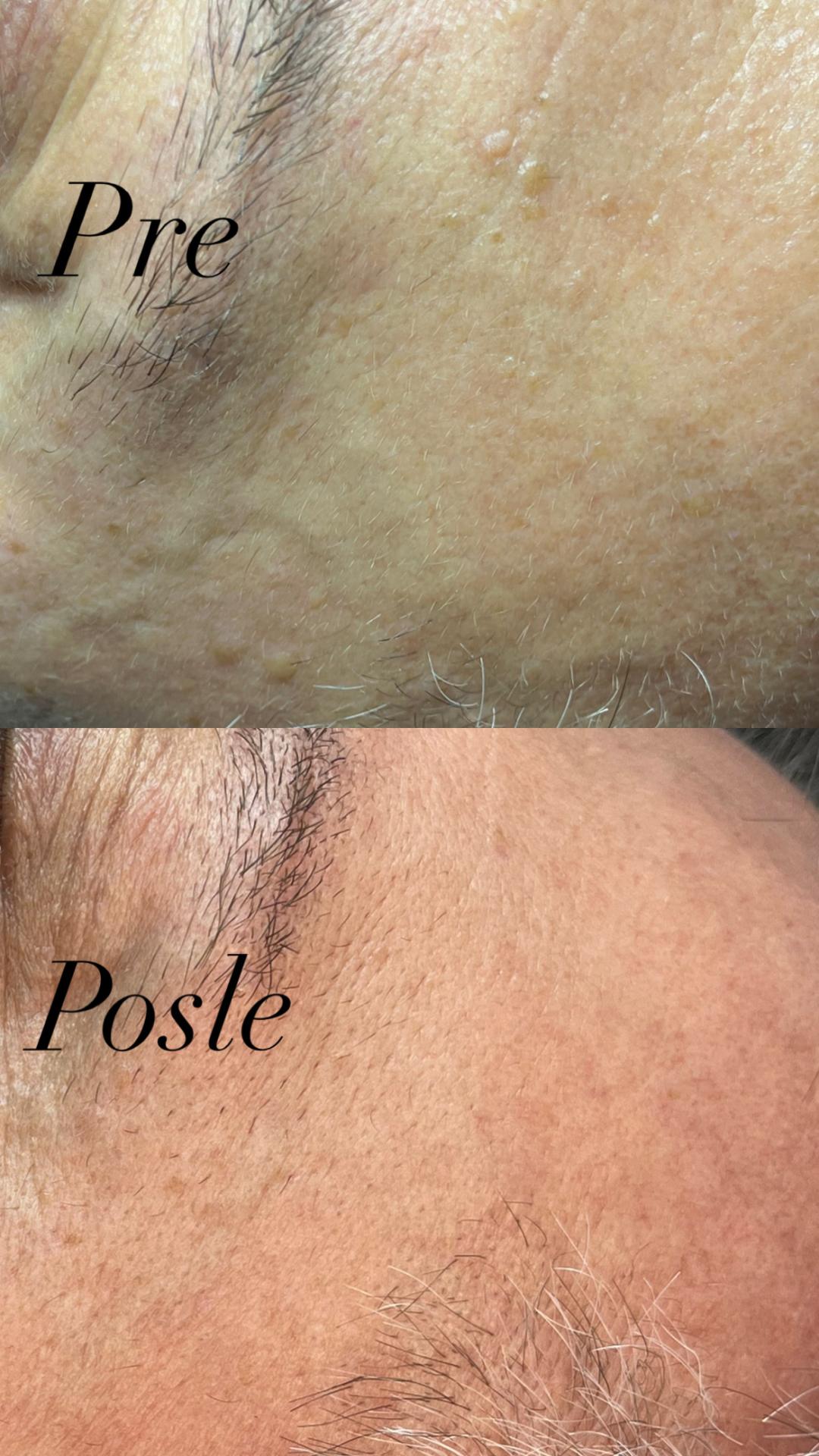 Belle Ana #beograd Tretman lica Phi-Ion tretman - bradavice / papilomi / keratoze / milije / hiperpigmentacija