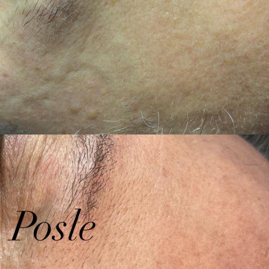 Belle Ana #beograd Tretman lica Phi-Ion tretman - bradavice / papilomi / keratoze / milije / hiperpi