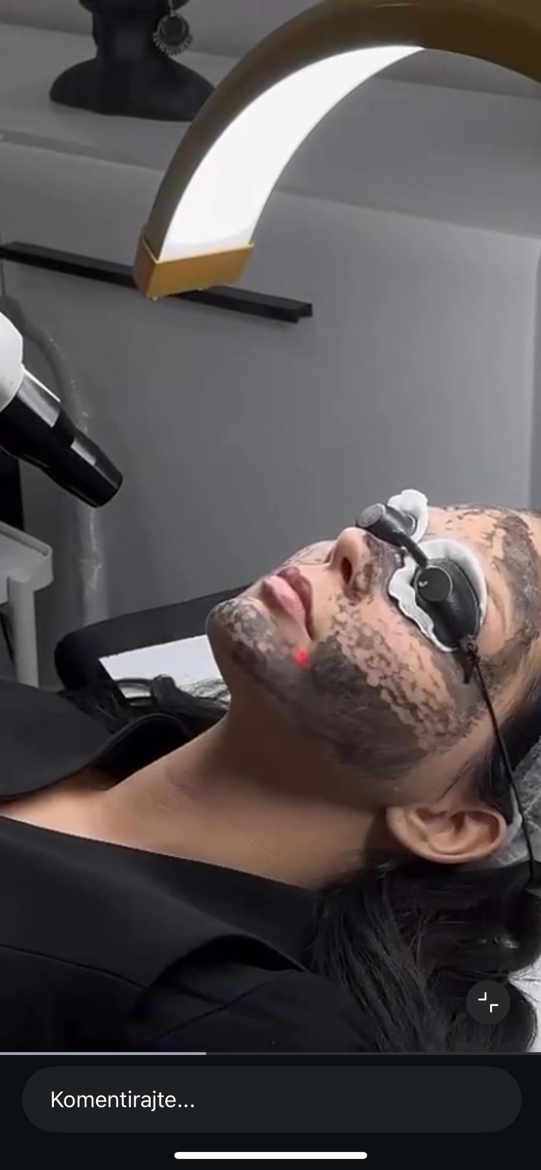 Belle Ana #beograd Tretman lica Karbon piling lica