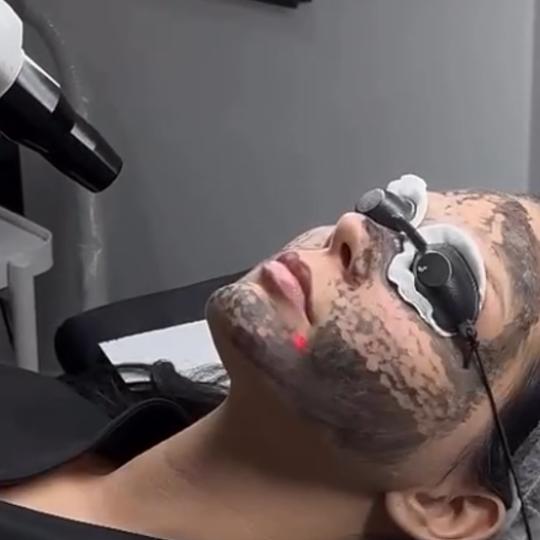 Belle Ana #beograd Tretman lica Karbon piling lica Karbon piling (holivudski piling) je brz, bezbola