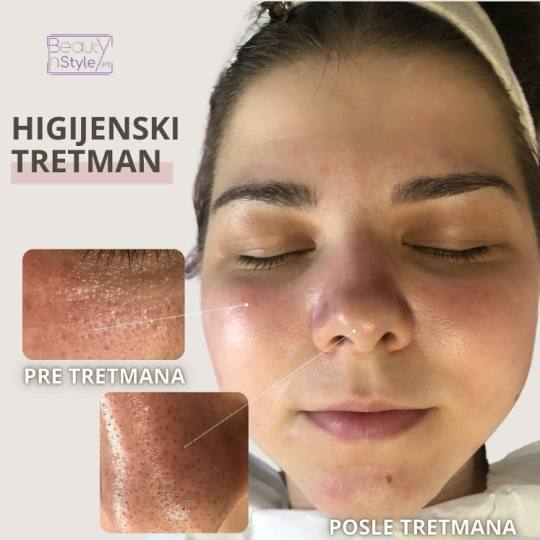 Beauty in Style DM #novisad Tretman lica Higijenski tretman lica 👀 Da li te nepravilnosti na licu