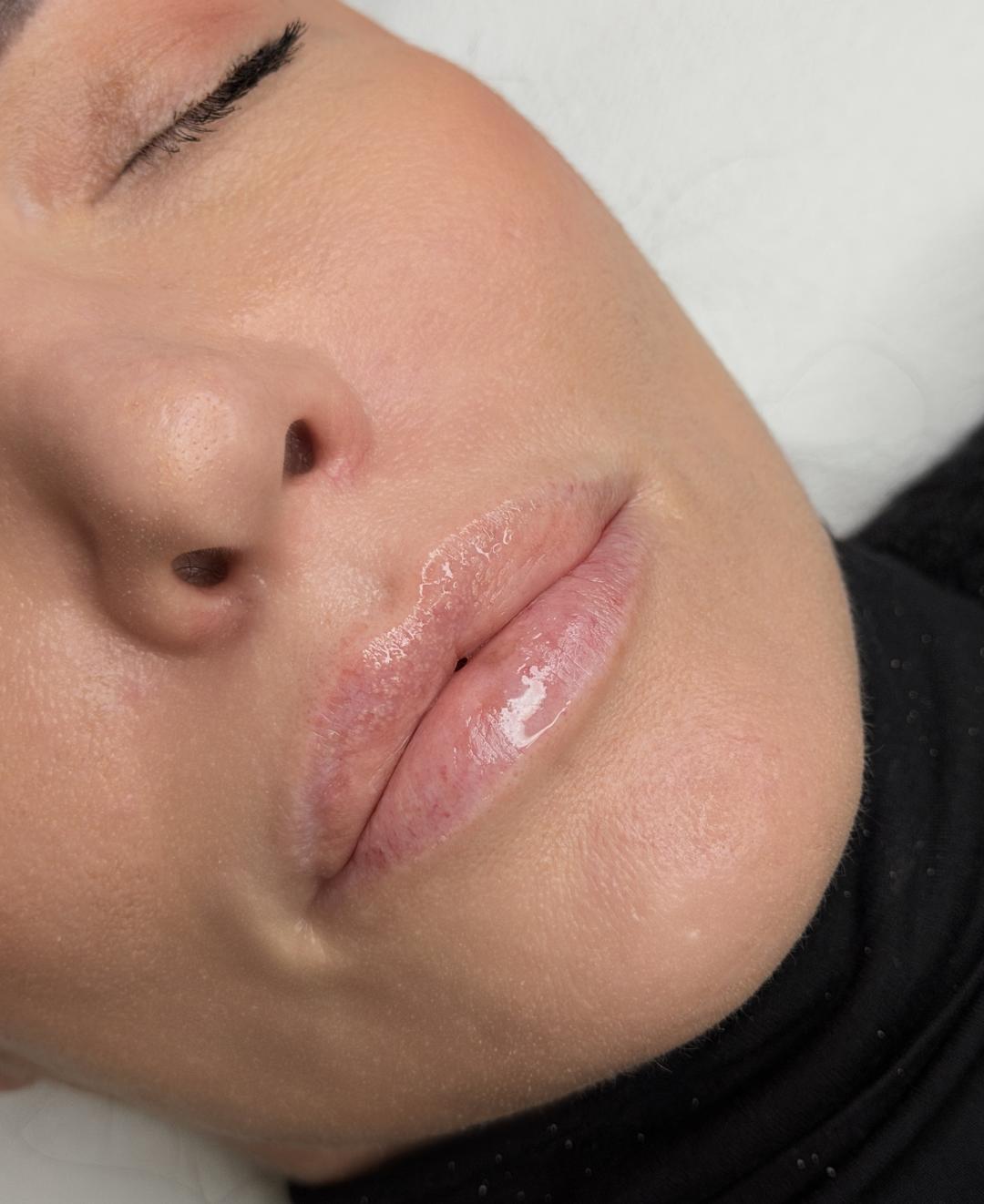 L’Avenue #beograd Mezoterapija lica Hydralips-mezoterapija usana hijaluronom