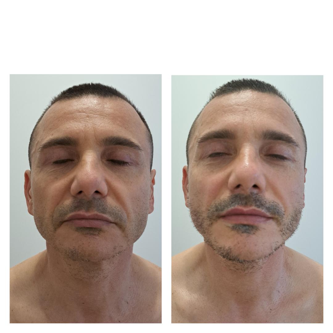 Face lift + bukalna masaža - Apolona, Beograd Masaža lica Lice Masaža lica, Beograd, Banovo brdo