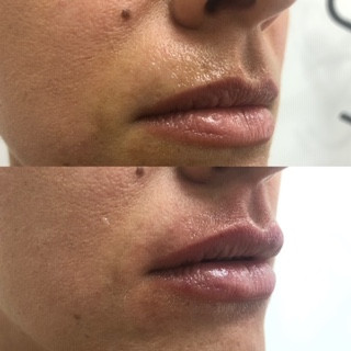 Ordinacija Stanojlović #krusevac Dermalni fileri Hijaluronski filer 1 ml - uvećavanje usana