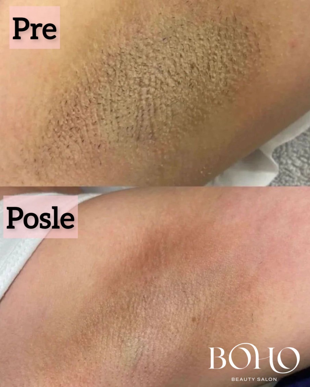 Boho Beauty #beograd Laserska epilacija Laserska epilacija pazuha - za dame