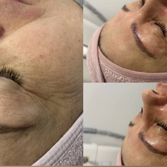Ks Laser Beauty Centar #beograd Kavitacija Booster paket - rejuvenacija + RF lica Booster paket - Pi