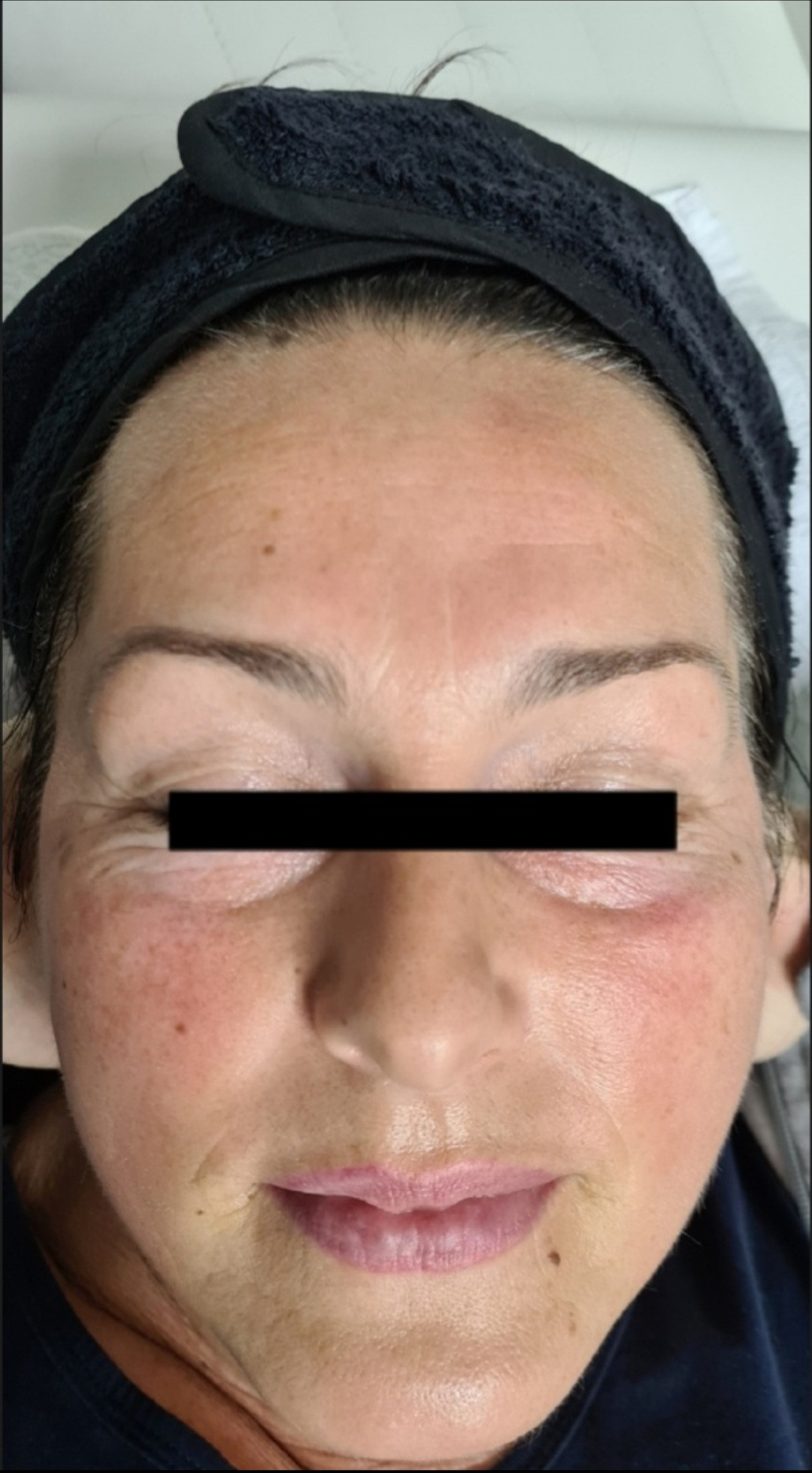 SunBox #beograd Masaža lica Face gym / Face fitness - anti age masaža lica