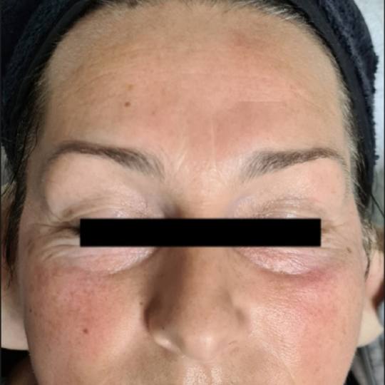 SunBox #beograd Masaža lica Face gym / Face fitness - anti age masaža lica