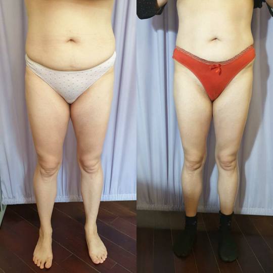 Mamey #beograd Anticelulit masaža Maderoterapija - paket od 10 tretmana + 1 gratis