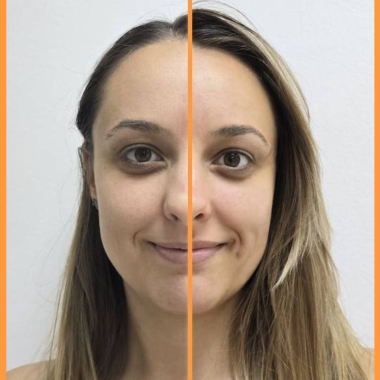Beauty by Marija Milojević #beograd Tretman lica Tretman vitaminom C Pre i posle tretmana sa vitami