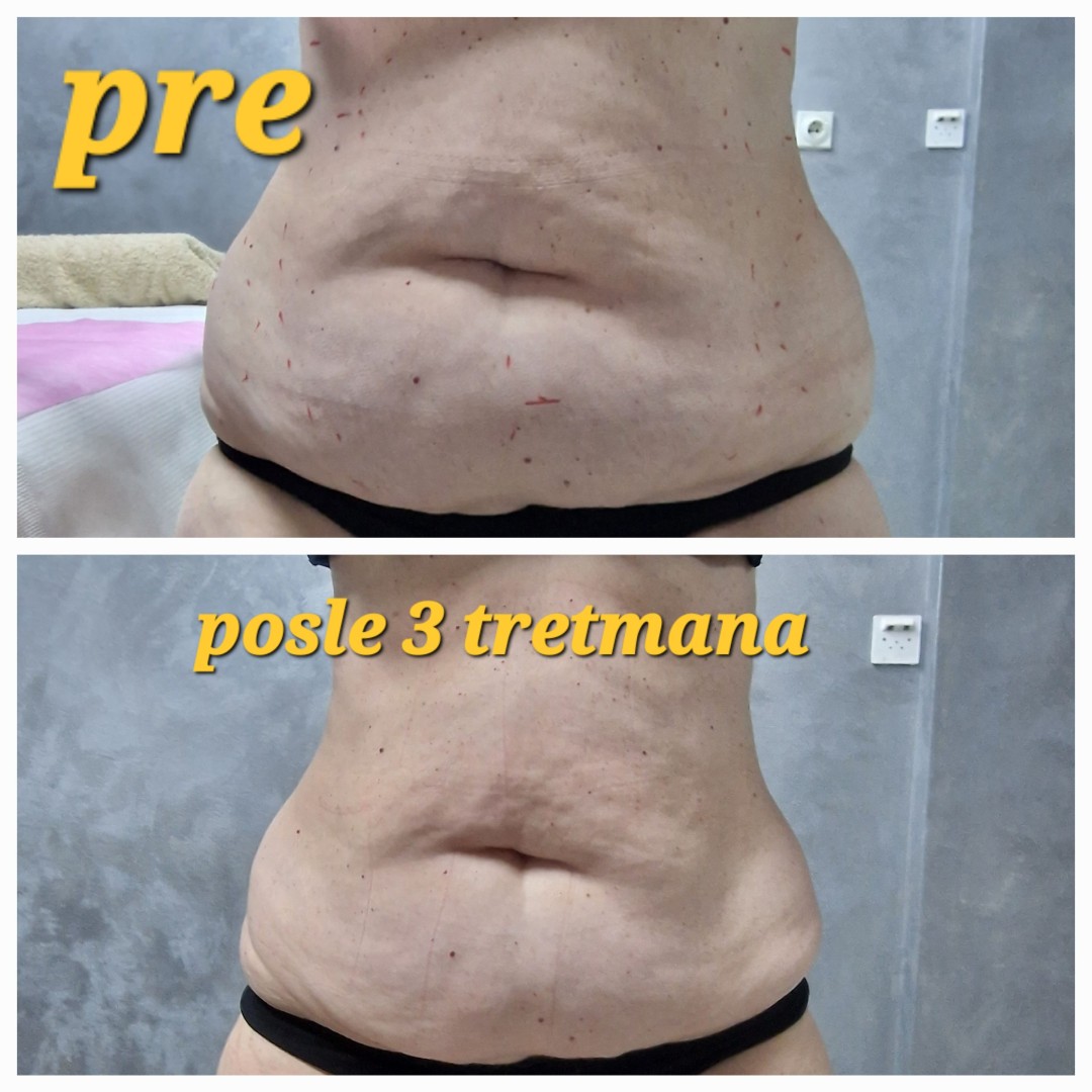 Seaside beauty #beograd Tretmani za mršavljenje Slimming sistem 2 u 1 - 1 regija 60'