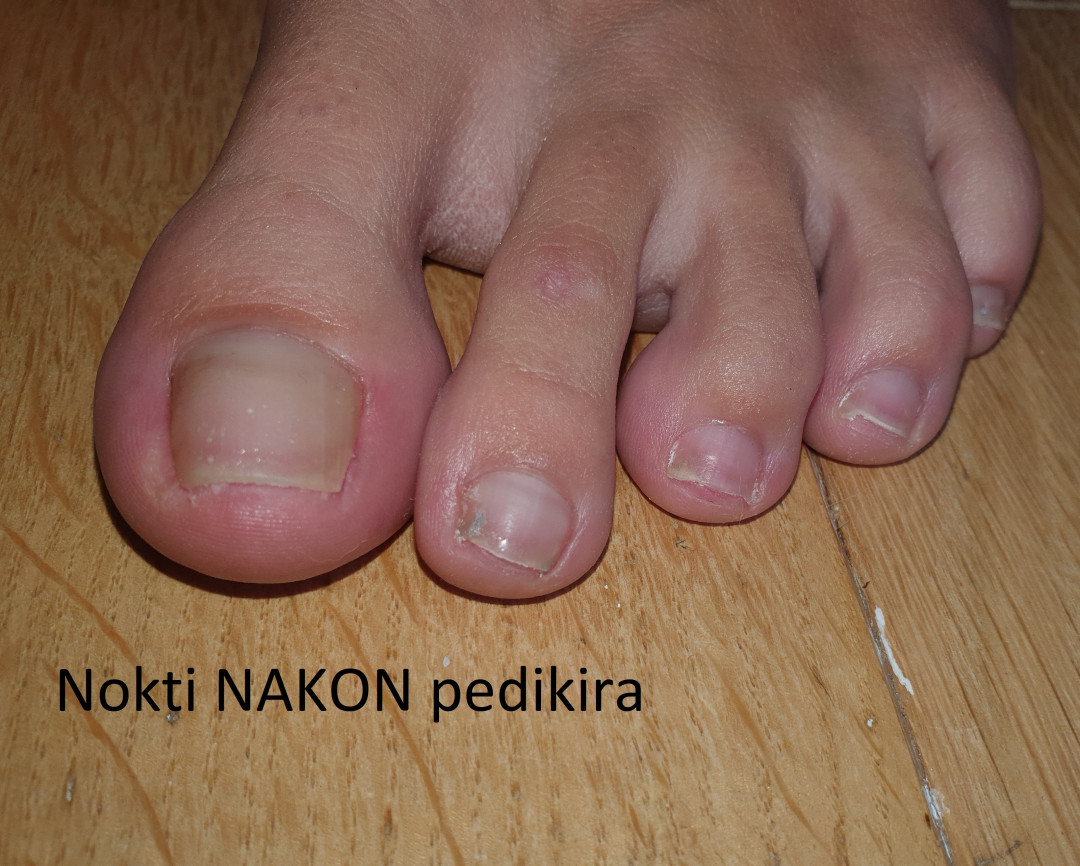 Mint #beograd Medicinski pedikir Medicinski pedikir