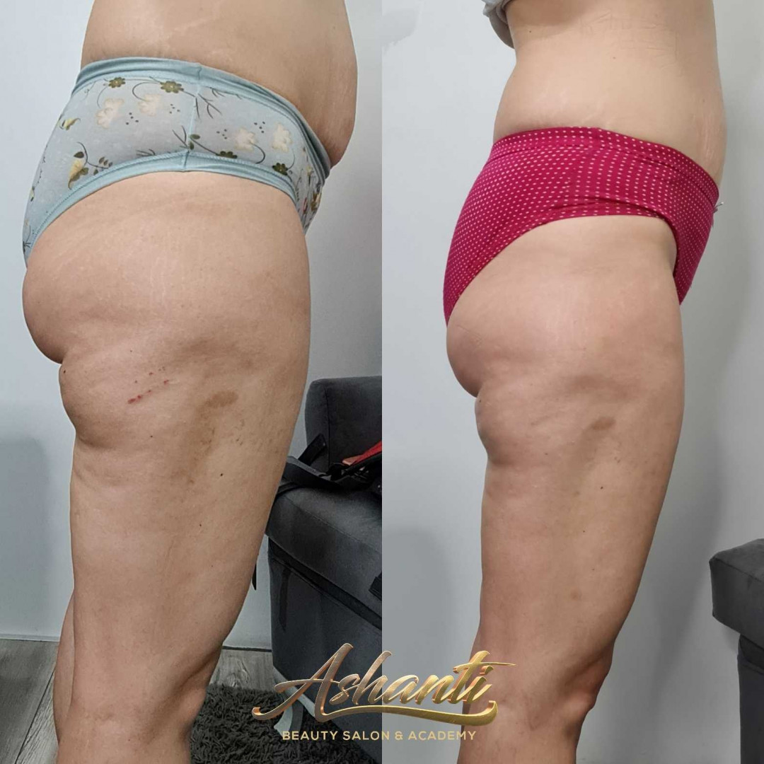 Ashanti Beauty Salon & Academy #beograd Masaža za mršavljenje Premium Maderoterapija - paket od 5 tretmana